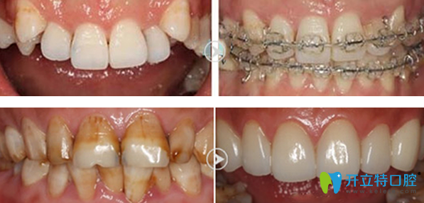 廣州穗華口腔正畸+牙齒美容修復效果案例