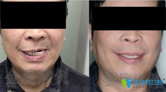 <!--<i data=20240703-sp></i>-->馬瀧齒科金辰allon4種植牙真實