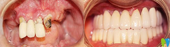 北京永康口腔多顆牙缺失種植案例