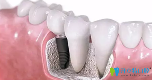 快速植牙技術