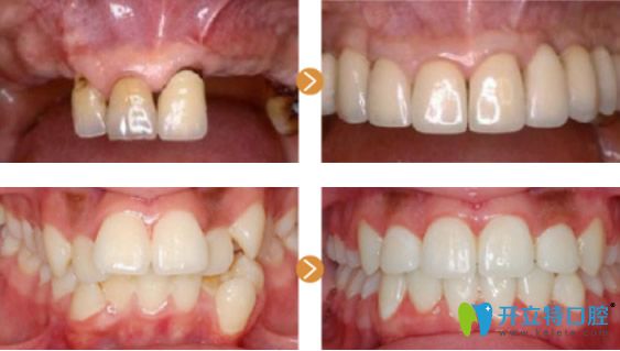 大眾口腔周先略主任看牙效果案例