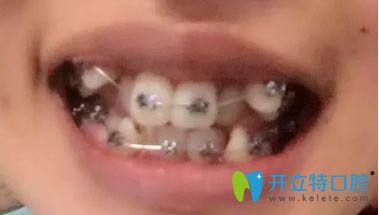 剛帶上金屬牙套 剛帶上金屬牙套