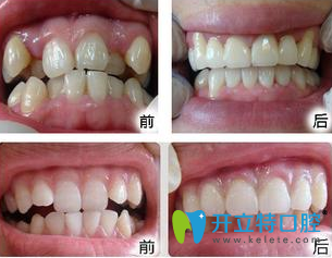 成都瑞泰口腔劉澤萍醫(yī)生牙齒矯正前后效果對比圖