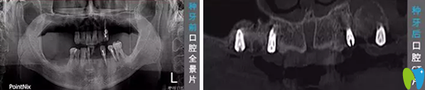 武漢咿呀口腔種植牙案例告訴我們 該帶缺牙的父母去看牙了