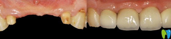 拜博口腔翟建博牙齒種植案例