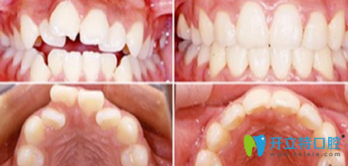 成都瑞泰口腔牙齒矯正前后效果對比圖