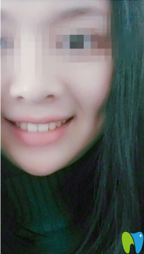 康圓口腔做的成人牙齒矯正 給大家看看正畸前后對(duì)比圖片