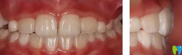 健齒口腔牙齒矯正效果案例