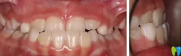 武漢健齒口腔MRC矯正牙齒前