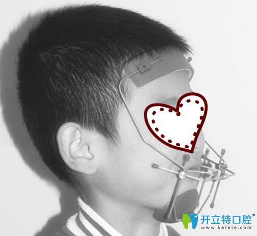 兒子戴頜前方牽引矯正裝置的照片