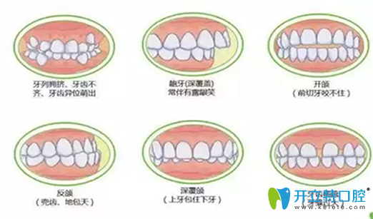 深度揭秘：在做牙齒矯正之前，你不得不了解的17個(gè)問(wèn)題