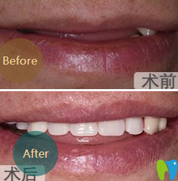 成都亞非牙科李顯軍半口牙種植前后效果對(duì)比圖