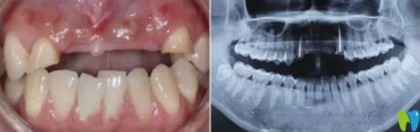 成都瑞爾口腔牙齒種植前