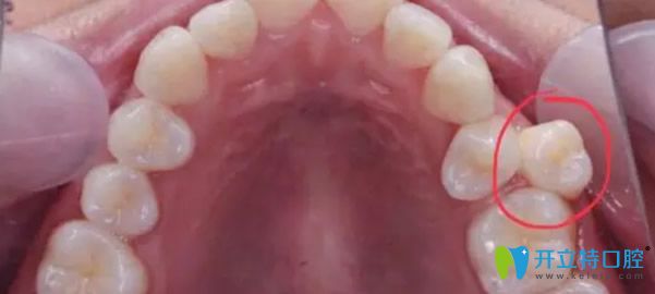 多生牙會排擠正常的牙齒