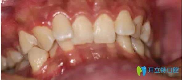 武漢愛(ài)齒爾口腔矯正牙齒前