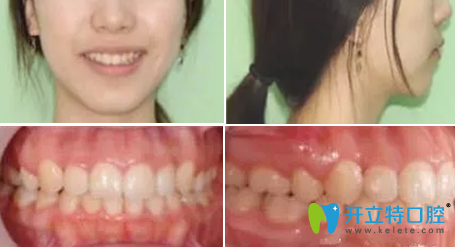 李女士在成都亞非牙科做隱形牙齒矯正一年的效果