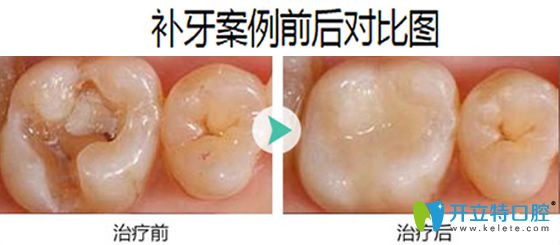 成都拜博口腔補牙案例前后對比圖