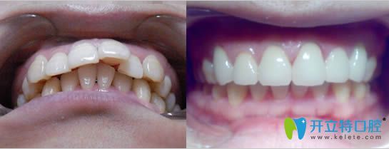 成都格林口腔牙齒正畸對比照片