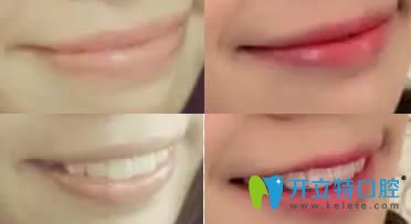 成都格林口腔牙齒正畸效果對(duì)比圖