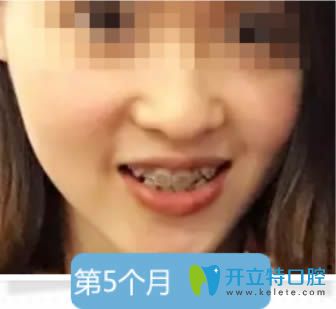 金屬托槽牙齒矯正5個(gè)月 金屬托槽牙齒矯正5個(gè)月