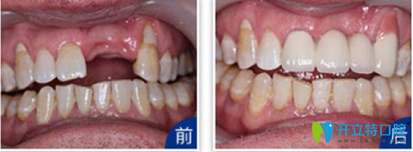 天津拜博口腔門(mén)牙缺失種植效果 天津拜博口腔門(mén)牙缺失種植效果