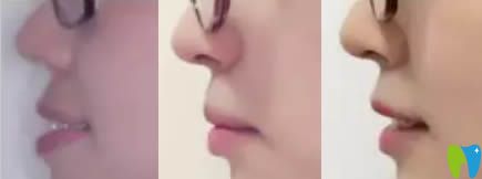 成都格林口腔門診隱適美牙齒正畸側(cè)面對(duì)比圖