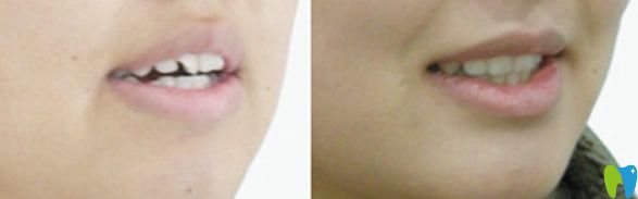 長沙優(yōu)伢仕口腔矯正前后效果對比圖