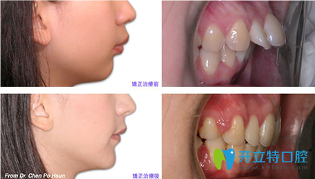 廈門(mén)天使口腔齙牙矯正前后對(duì)比圖