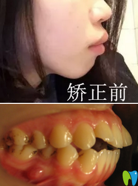 來看本人在廈門登特口腔做牙齒矯正減3200元費用