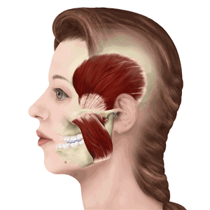 戴牙套導(dǎo)致的咀嚼減少肌肉萎縮動(dòng)態(tài)示意圖