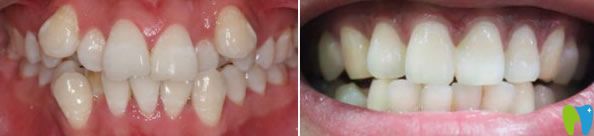 劉赤東院長(zhǎng)牙齒正畸案例見(jiàn)證