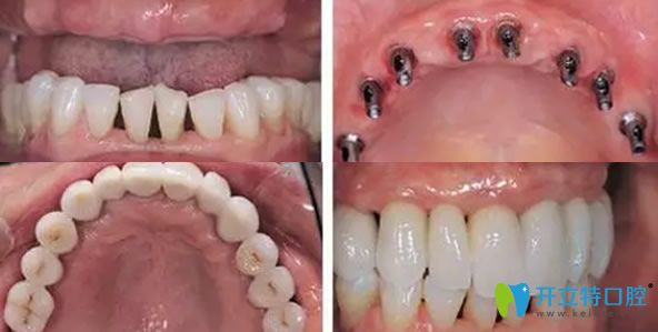 譚建武院長(zhǎng)牙齒種植案例 譚建武院長(zhǎng)牙齒種植案例
