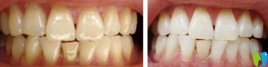 昆明拜博口腔怎么樣？親們可以參考我的潔牙<span style=