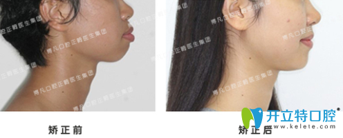 杭州博凡齒科盧海平牙齒矯正案例效果圖 杭州博凡齒科盧海平牙齒矯正案例效果圖