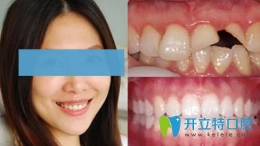 拜博口腔門牙缺損烤瓷牙修復(fù)案例 拜博口腔門牙缺損烤瓷牙修復(fù)案例
