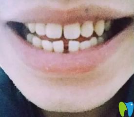 沙牙祖口腔隱形矯正牙齒前