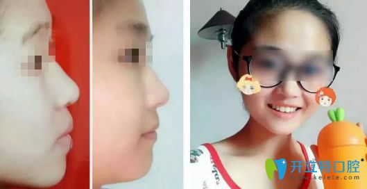 美奧口腔隱形矯正牙齒18個月后的效果