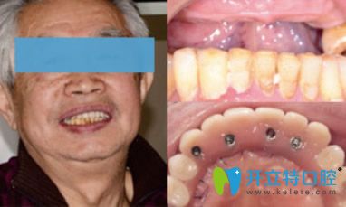 <!--<i data=20240703-sp></i>-->口腔半口牙缺失種植效果 <!--<i data=20240703-sp></i>-->口腔半口牙缺失種植效果