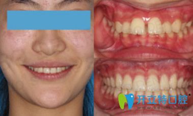 拜博口腔隱形矯正牙齒案例 拜博口腔隱形矯正牙齒案例