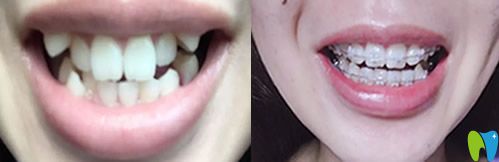 無(wú)錫臻品口腔牙齒矯正前后效果對(duì)比圖一覽