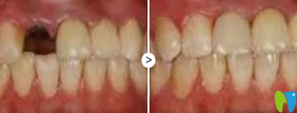 寧波口腔種植牙前后效果對(duì)比圖