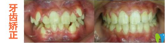 杭州美奧兒童牙齒矯正前后對(duì)比效果