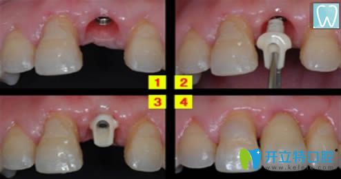 成都維朗口腔種植牙效果圖 成都維朗口腔種植牙效果圖