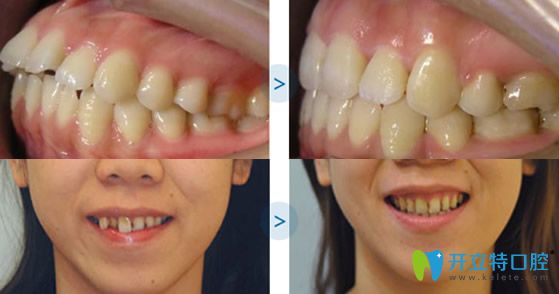 福州維樂口腔牙齒矯正術(shù)前術(shù)后對(duì)比案例