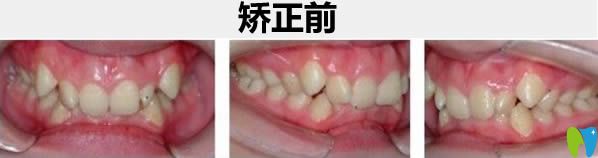 牙齒擁擠矯正術(shù)后照