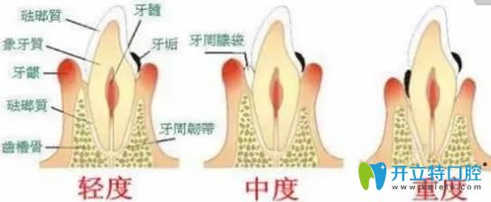 牙齦萎縮怎么辦該怎樣治療?萎縮的牙齦還能長回來嗎