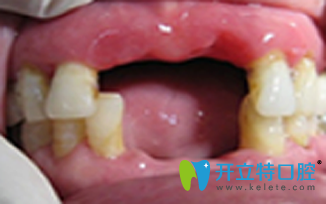 在北京維樂口腔做微創(chuàng)無痛種植牙前 在北京維樂口腔做微創(chuàng)無痛種植牙前