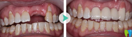 福州維樂口腔張俊偉怎么樣？看牙齒種植案例效果