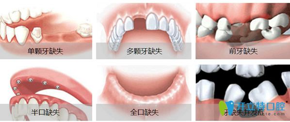 種植牙適應(yīng)的人群
