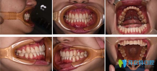 青島拜博口腔矯正牙齒一年半后效果 青島拜博口腔矯正牙齒一年半后效果